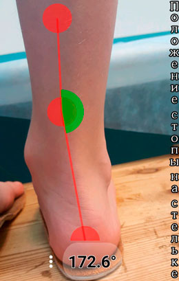 Правая стопа на ортопедической стельке - измерение угла
